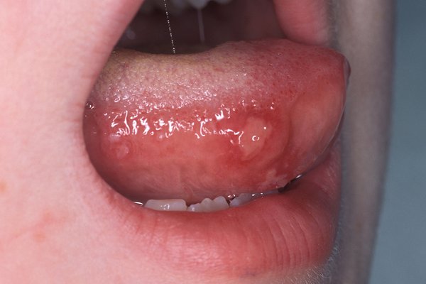 Mouth Throat Teen