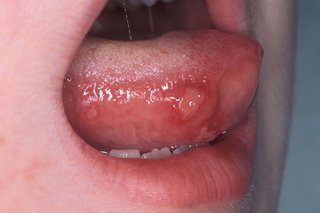 A round, red ulcer with a lighter pink centre on the side of a child's tongue. The tongue has a creamy white coating on top.