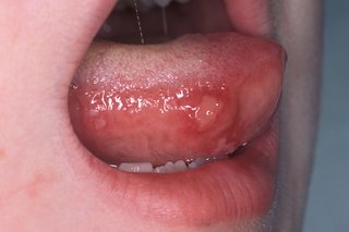 A round, red ulcer with a lighter pink centre on the side of a child's tongue. The tongue has a creamy white coating on top. Shown on white skin.