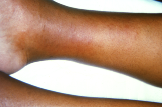 在一个人的小腿上的静脉炎的特写。右脚踝上有一个深红色的区域。显示在中等棕色的皮肤上。