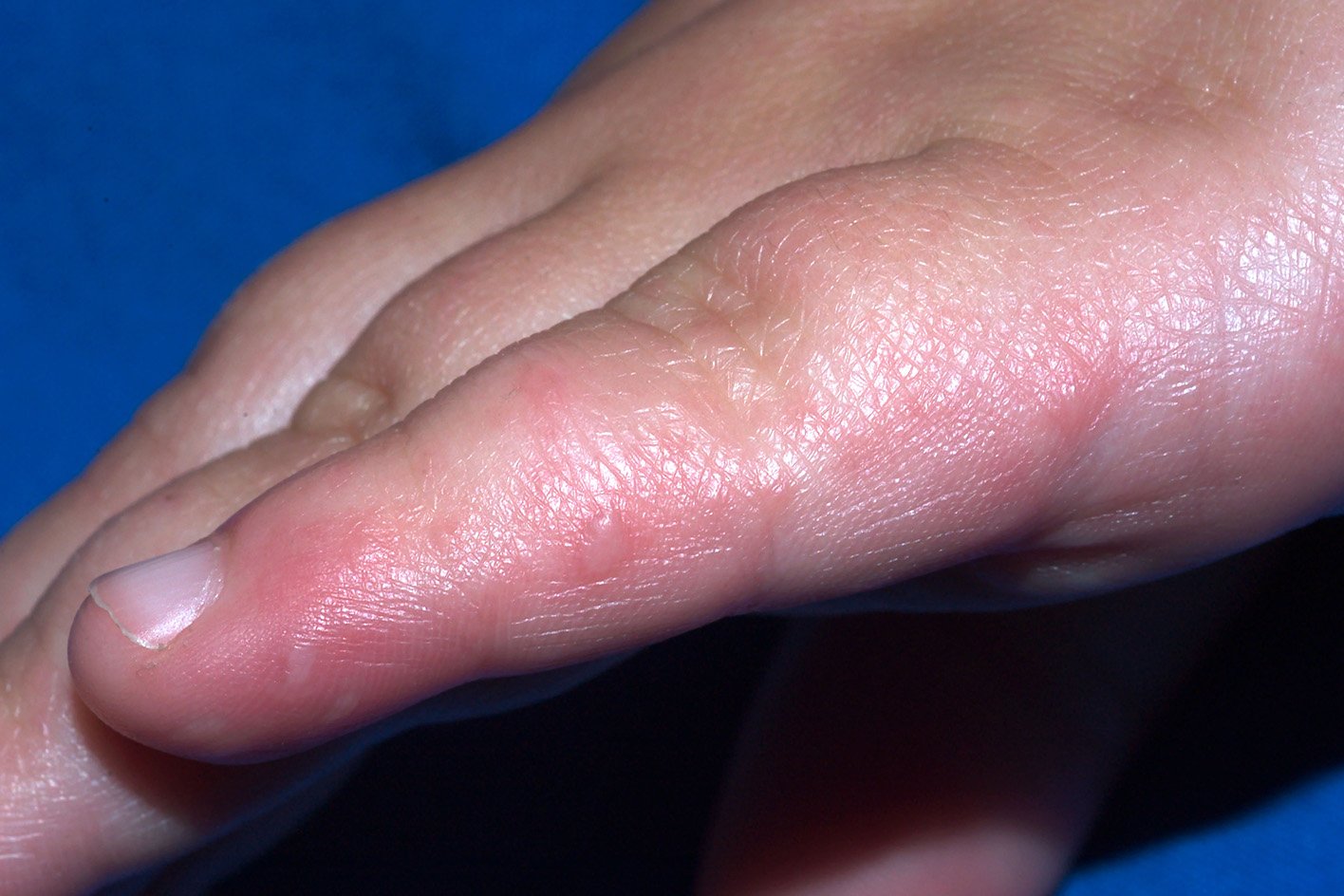 spots-on-toes-and-rashes-join-weird-new-symptoms-of-coronavirus