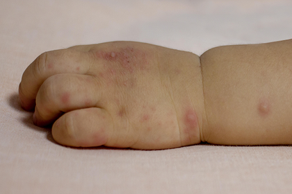 Hand, foot and mouth disease spots on a baby's hand and wrist on white skin. A more detailed description is available next.