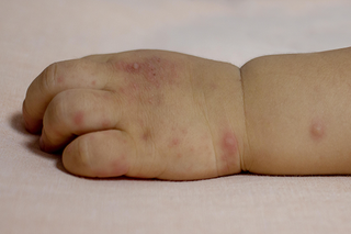 Small, round, pink blisters on a child's hand and wrist, from hand, foot and mouth disease. Shown on white skin.