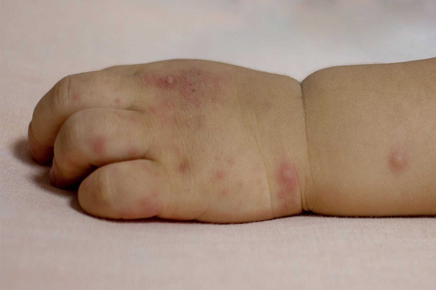 Rashes In Babies And Children NHS
