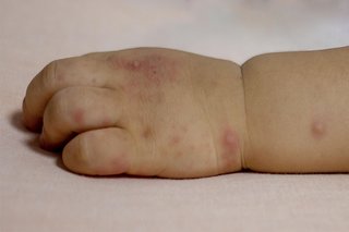 Small, round, pink blisters on a child's hand and wrist, from hand, foot and mouth disease. Shown on white skin.