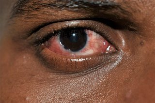 An eye that's red, caused by conjunctivitis. Shown on brown skin.