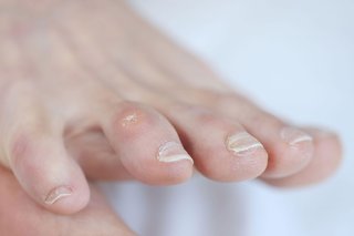 A corn on the toe of a person with white skin. There's a small, round, pink lump of hard skin with dry skin in the middle.