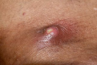 A skin abscess about 1cm wide on the body of a person with medium brown skin. The edge of the abscess is dark brown and the middle is pale with pus visible in the centre.