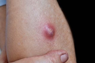 A skin abscess about 2cm wide, on the arm of a person with white skin. The area around the abscess is red and the middle is pale and filled with pus.