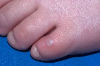 A round, grey blister on the top of a child's toe. The skin around it is pink. Shown on white skin.