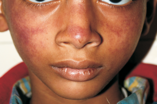A purple-red rash on the face and nose of a child with medium brown skin.