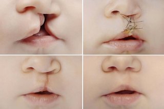 4 images showing changes to a baby's nose and mouth during cleft lip treatment. First image shows a gap from the top lip up to 1 of the nostrils where 1 side of the nose is lower than the other. Second image shows stitches closing the gap and repairing the nostril. Third image shows a scar from the top lip to the nostril. Fourth image shows a faded scar with repaired cleft lip and the nose looking even on both sides