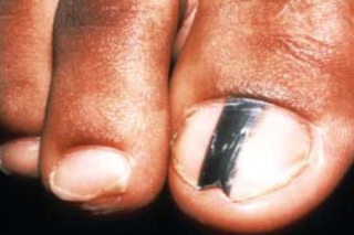 The toes of a person with dark brown skin. There is a thick, black, vertical line caused by melanoma through the middle of their big toenail.