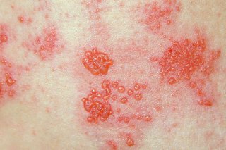 Shingles rash shown on white skin. Close up of patches of small red blisters oozing fluid. The skin around the blisters is pink.