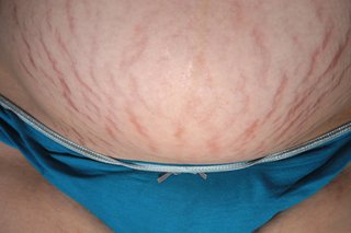 Close-up of a person’s tummy showing a number of red lines (stretch marks) on their skin. The image shown is on white skin.
