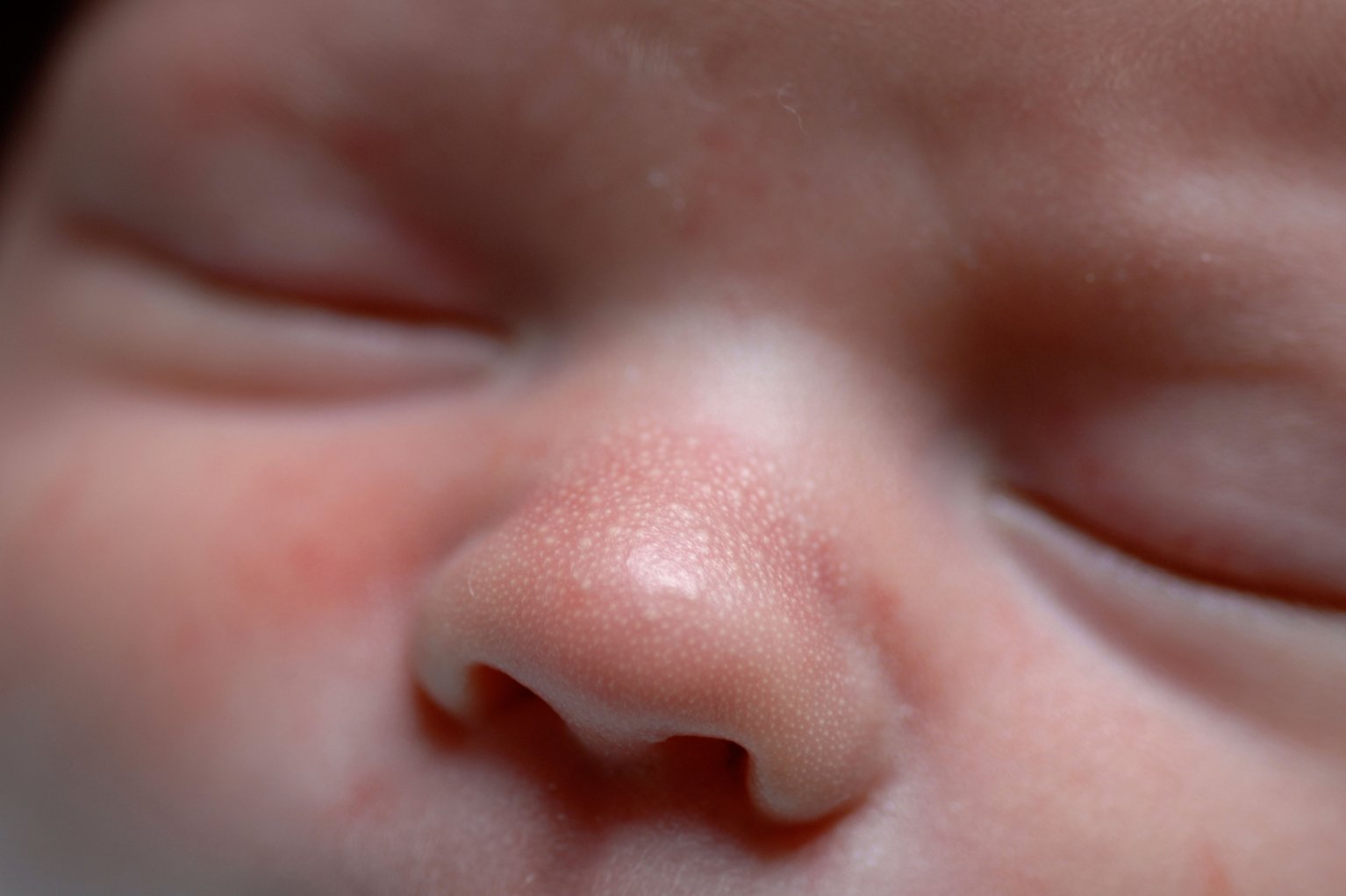 婴儿头上鲜红斑痣图片（宝宝出现这种红斑）-幼儿百科-魔术铺