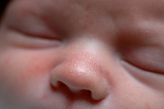 Lots of white spots on a baby's nose. The spots are very small and close together. Shown on white skin.