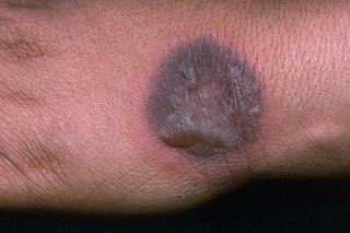 Erythema multiforme on dark brown skin. There's a round, raised spot that's darker than the skin with a pink ring around it.