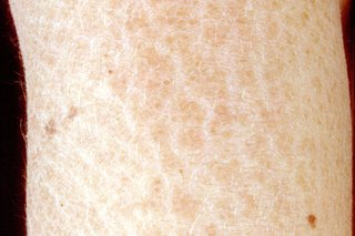 A close-up showing the scale-like dryness of ichthyosis on white skin.