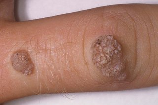 Two brown, raised, rough lumps (warts) on a person's finger. Shown on white skin.