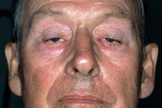 A close-up of a man with droopy eyelids caused by myasthenia gravis