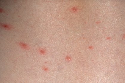 Stage 1 chickenpox, white skin. Spots are red and pink. Some are raised. A more detailed image description is available next.