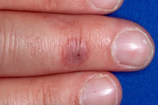 A circular, purple mark on the middle finger of a person with white skin. The mark is slightly smaller than their fingernail.