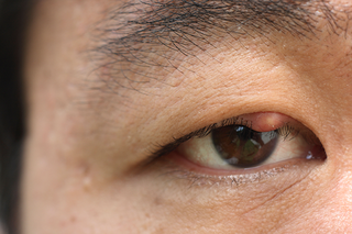 The stye is a round, slightly red lump on the upper lid by the eyelashes. The rest of the eye looks normal.