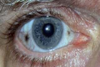 Close-up of an eye. The iris is blue, with a medium-sized pupil. There is a dark brown spot in the white of the eye, to the left of the iris, and a smaller brown dot to the right.