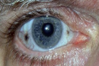 Close-up of an eye. The iris is blue, with a medium-sized pupil. There is a dark brown spot in the white of the eye, to the left of the iris, and a smaller brown dot to the right.