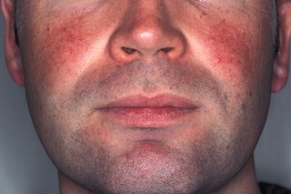 Picture of red patches caused by rosacea on the cheeks of a man with white skin.