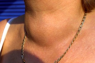 A large swelling across the lower front of a woman's neck.