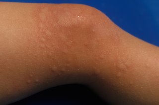 Raised patches and redness on a child's knee, caused by hives. Shown on light brown skin.