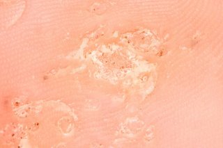 Close-up of white, raised, crusty-looking patches of skin (mosaic warts) on a person with white skin.