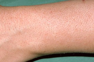 Small pink bumps close together with rough, dry skin. Shown on white skin.