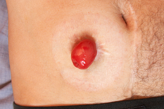 Tummy of a man with white skin and an end ileostomy, which is dark pink and around 4cm long and 3cm wide.