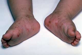 A child's feet with many dark red spots from scabies. Some spots have redness around them. Shown on white skin.