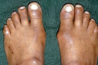 Bunions on both feet. There are lumps on the sides of the feet below the big toes, but the one on the right foot is bigger.