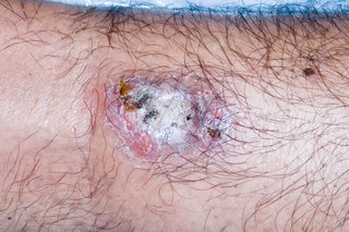 Picture of pyoderma gangrenosum