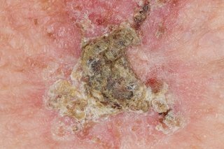Picture of actinic keratosis patch