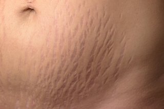 Stretch Marks On Breasts Teenagers