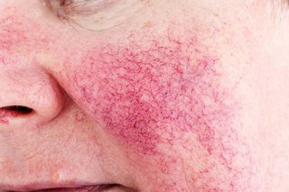 Picture of broken blood vessels caused by rosacea on the cheek of a woman with white skin.