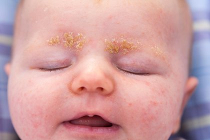 Raised yellow cradle cap crusts on the eyebrows of a baby with white skin. A long description is available next.