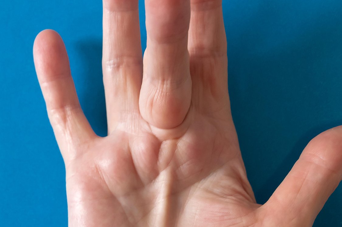 dupuytren-s-contracture-nhs