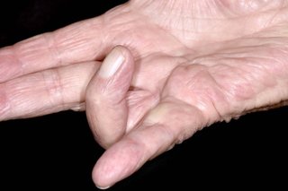 A hand held out flat with the palm facing upwards. The ring finger is bent in towards the palm.