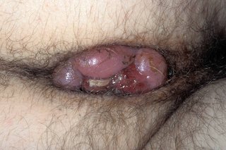 A close-up of severe piles. There are several large pink and purple, grape-sized lumps surrounding the anus.