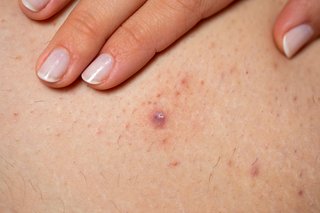 An infected ingrown hair with pus at it centre