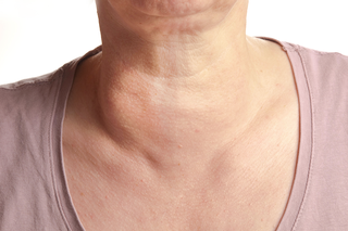 A smooth swelling at the lower front right side of a woman's neck.