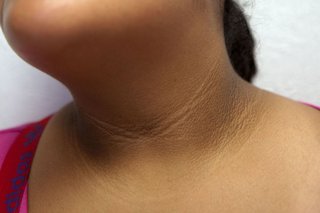 Dark patches of skin that form a band around the lower part of the neck on a person with medium brown skin.