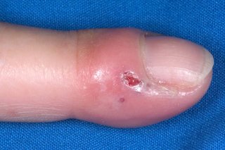 A red and swollen fingertip with a small sore at the side of the nail. Shown on white skin.